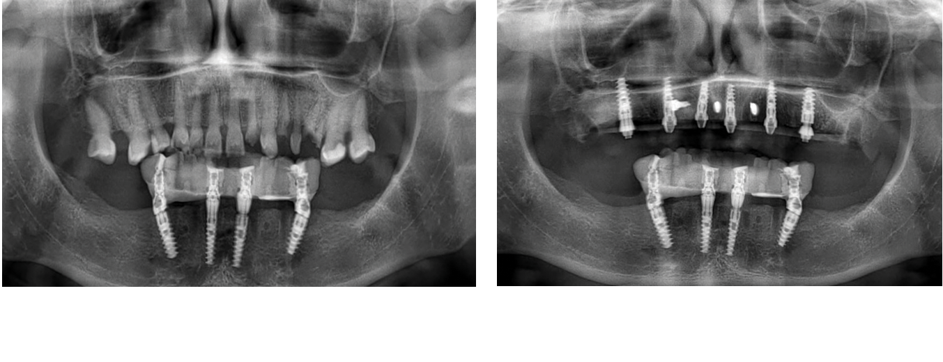 Dr. Oscar Marin | ​Full Arch Course